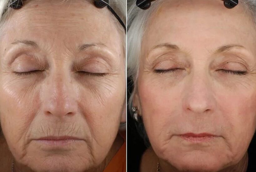 The results of the fractional rejuvenation